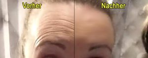 Botox statt Dr Juchheim Cosmetics - Vorher-Nachher - Vorsicht vor Kosmetik - Bianca Döhring - Testbericht