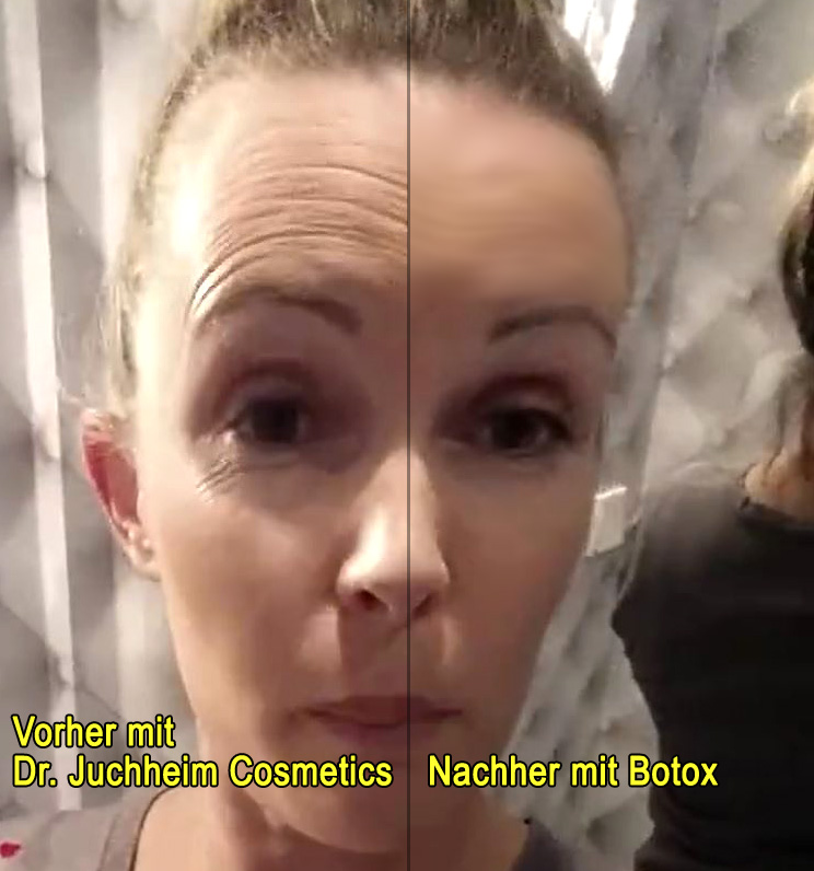 Botox statt Dr Juchheim Cosmetics - Vorher-Nachher - Vorsicht vor Kosmetik - Bianca Döhring - Testbericht